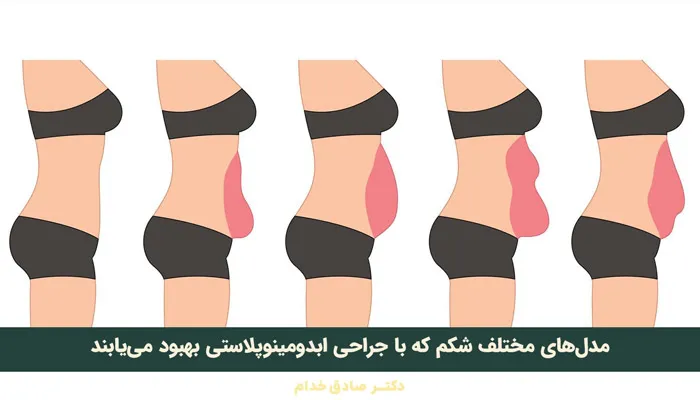 انواع شکم مناسب برای جراحی تامی تاک (ابدو)