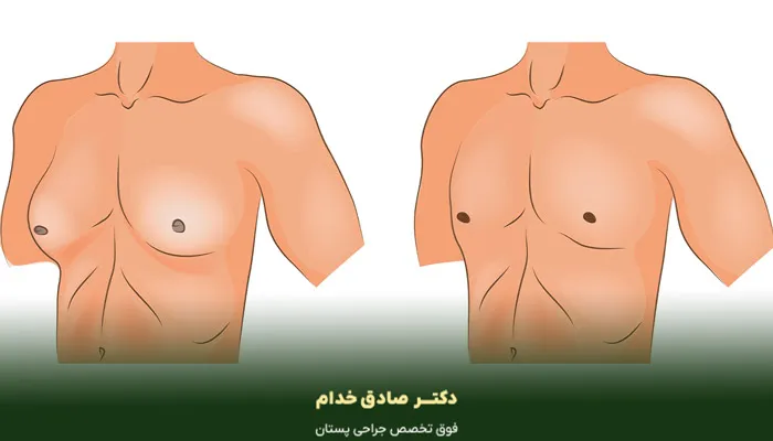 درمان جراحی ژنیکوماستی