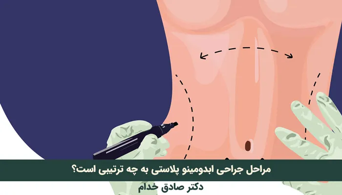 مراحل انجام جراحی ابدومینوپلاستی