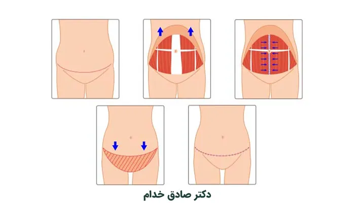 تصویر اینفوگرافیک درباره جراحی ابدومینوپلاستی