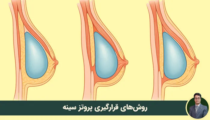 پروتز به چند روش در سینه قرار میگیرد؟