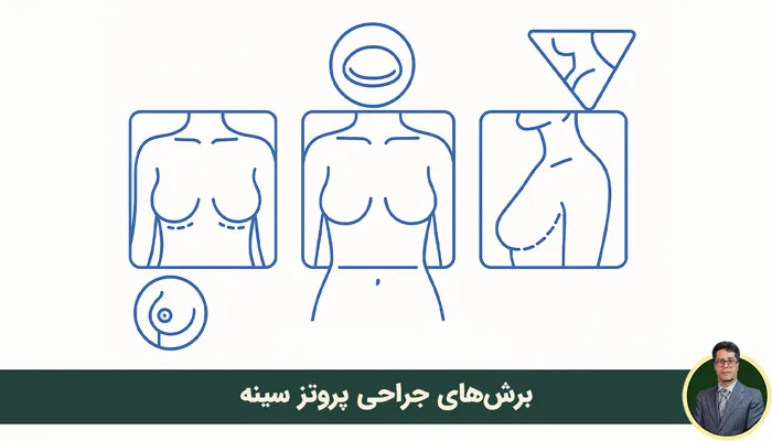 برش سینه در جراحی پروتز چطوری انجام میشه؟