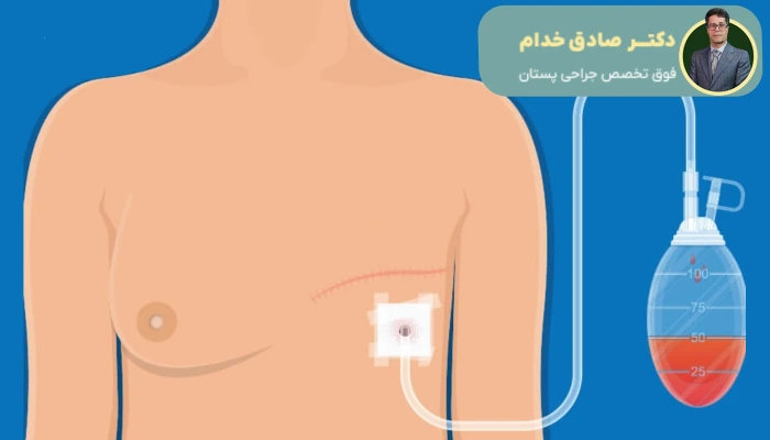 انواع روشهای بازسازی پستان