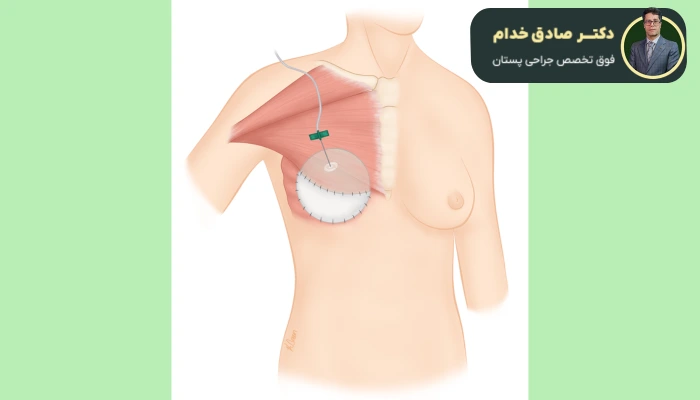 مزایای جراحی بازسازی پستان